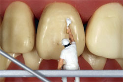 Воздействие фторида на зубы и костную ткань. Способы уменьшения концентрации фторида в воде в домашних условиях: системы обратного осмоса и  фильтры с активированным оксидом алюминия.